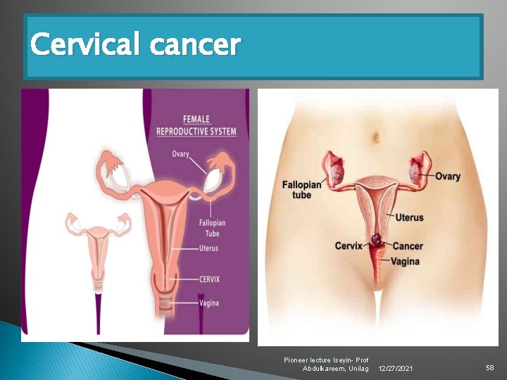 Cervical cancer Pioneer lecture Iseyin- Prof Abdulkareem, Unilag 12/27/2021 58 