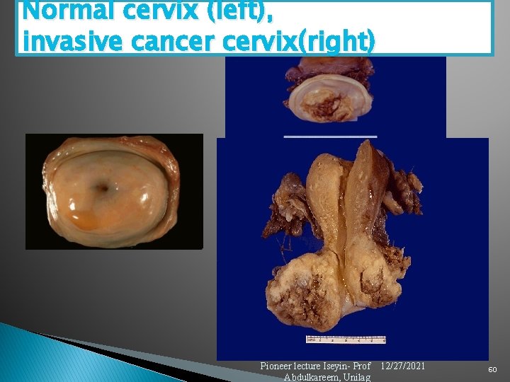 Normal cervix (left), invasive cancer cervix(right) Pioneer lecture Iseyin- Prof Abdulkareem, Unilag 12/27/2021 60