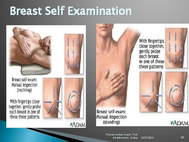 Breast Self Examination Pioneer lecture Iseyin- Prof Abdulkareem, Unilag 12/27/2021 69 