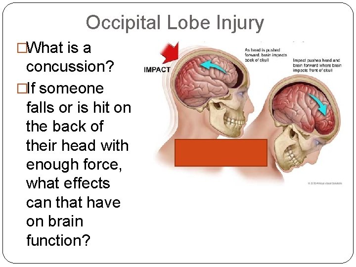 Occipital Lobe Injury �What is a concussion? �If someone falls or is hit on Occipital Lobe Injury �What is a concussion? �If someone falls or is hit on