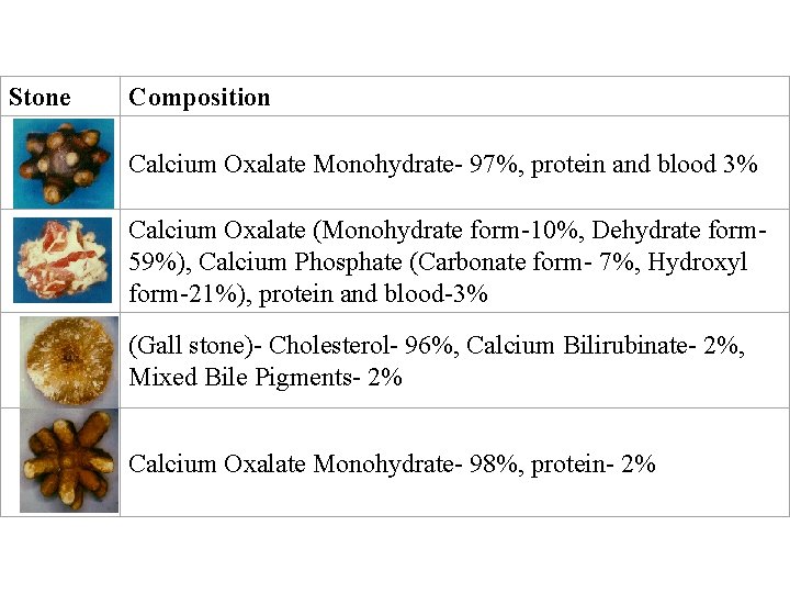 Stone Composition Calcium Oxalate Monohydrate- 97%, protein and blood 3% Calcium Oxalate (Monohydrate form-10%,