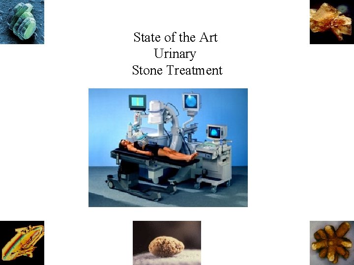 State of the Art Urinary Stone Treatment 