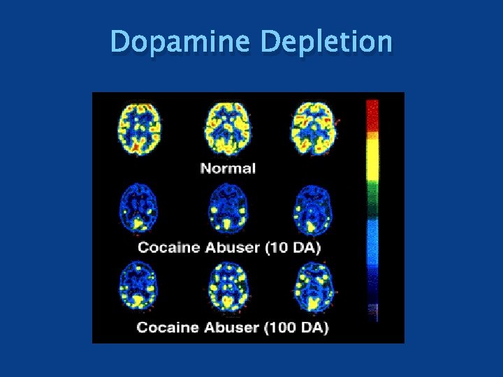 Dopamine Depletion 