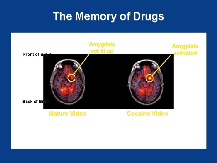 The Memory of Drugs Front of Brain Amygdala not lit up Amygdala activated Back