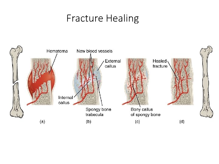 Fracture Healing 