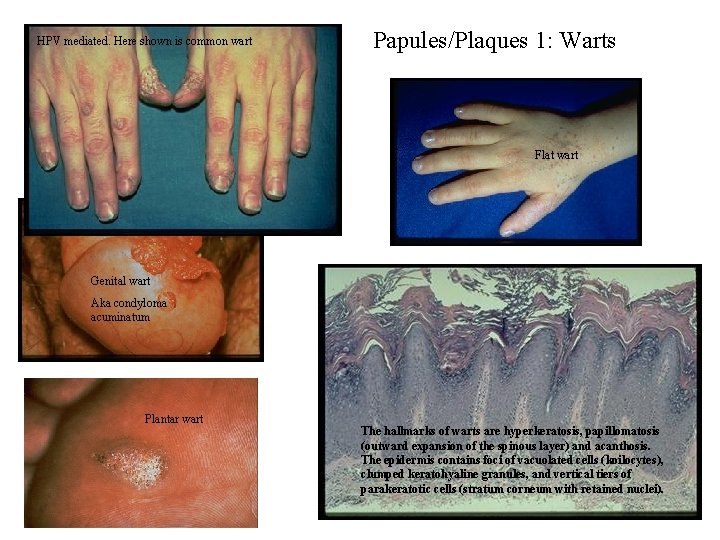 HPV mediated. Here shown is common wart Papules/Plaques 1: Warts Flat wart Genital wart