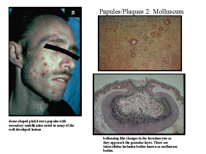 Papules/Plaques 2: Molluscum dome-shaped pink-brown papules with secondary umbilication noted in mnay of the