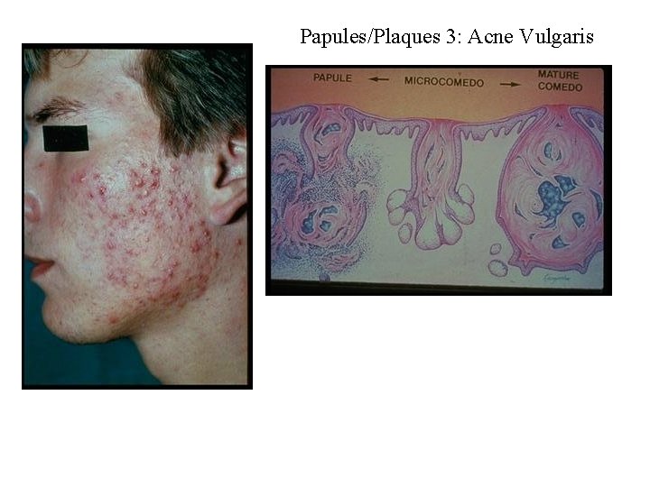 Papules/Plaques 3: Acne Vulgaris 