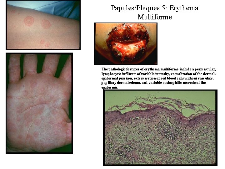 Papules/Plaques 5: Erythema Multiforme The pathologic features of erythema multiforme include a perivascular, lymphocytic