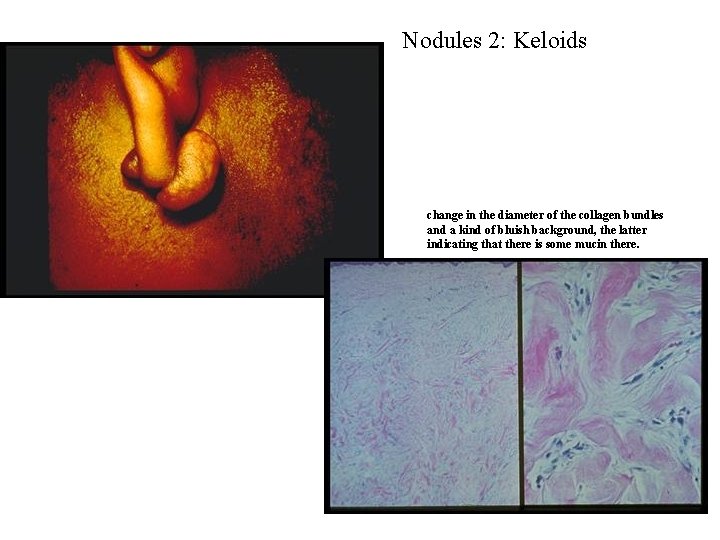 Nodules 2: Keloids change in the diameter of the collagen bundles and a kind