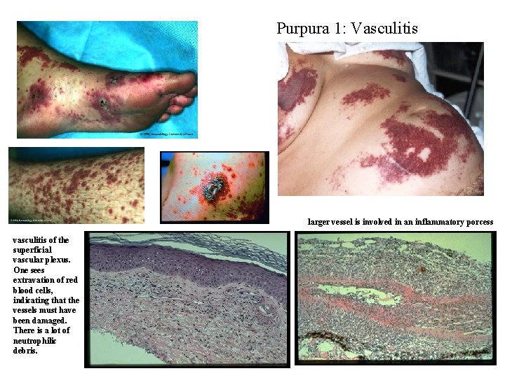 Purpura 1: Vasculitis larger vessel is involved in an inflammatory porcess vasculitis of the