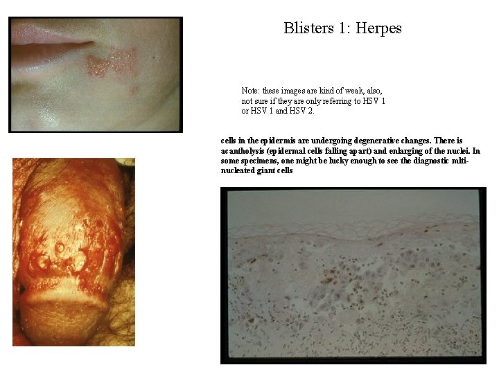 Blisters 1: Herpes Note: these images are kind of weak, also, not sure if