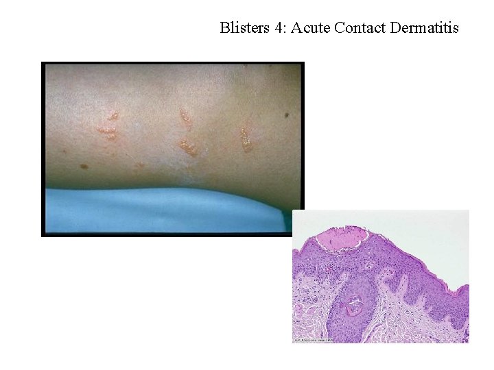 Blisters 4: Acute Contact Dermatitis 