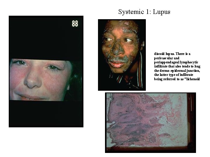 Systemic 1: Lupus discoid lupus. There is a perivascular and periappendageal lymphocytic infiltrate that