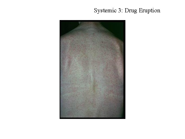 Systemic 3: Drug Eruption 