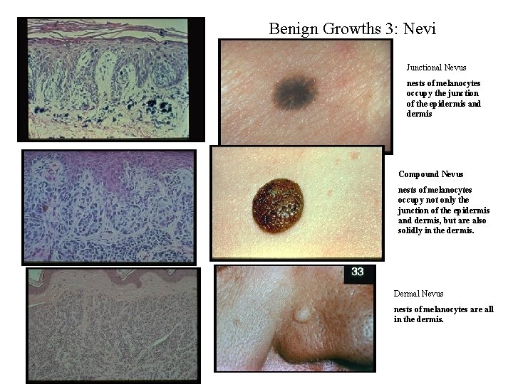 Benign Growths 3: Nevi Junctional Nevus nests of melanocytes occupy the junction of the