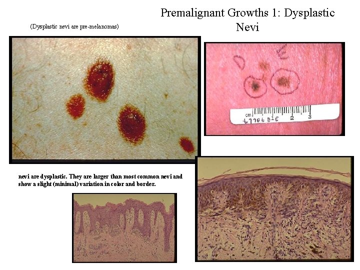 (Dysplastic nevi are pre-melanomas) Premalignant Growths 1: Dysplastic Nevi nevi are dysplastic. They are