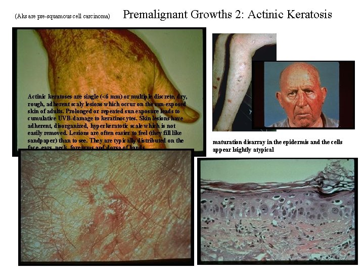 (Aks are pre-squamous cell carcinoma) Premalignant Growths 2: Actinic Keratosis Actinic keratoses are single