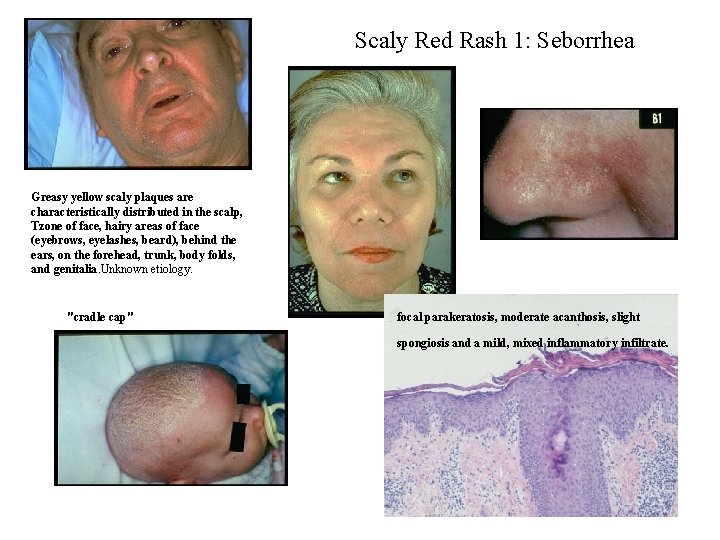 Scaly Red Rash 1: Seborrhea Greasy yellow scaly plaques are characteristically distributed in the