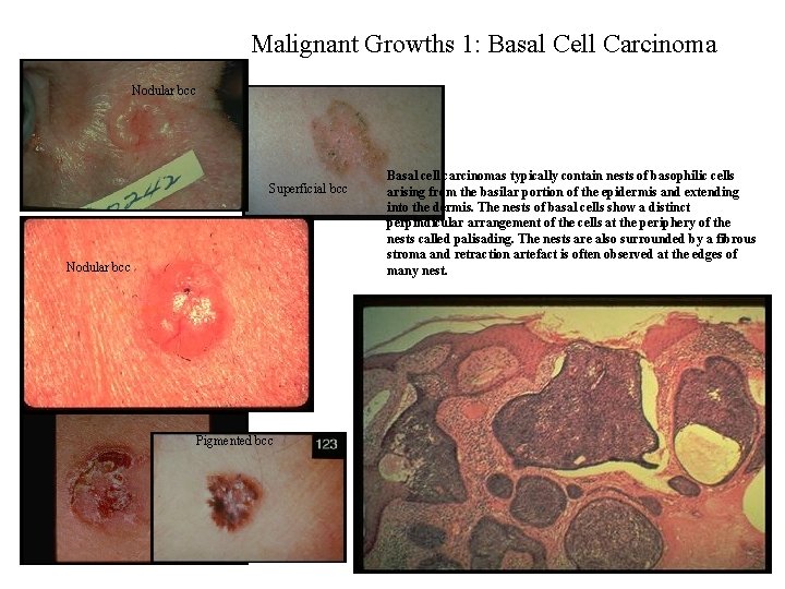 Malignant Growths 1: Basal Cell Carcinoma Nodular bcc Superficial bcc Nodular bcc Pigmented bcc