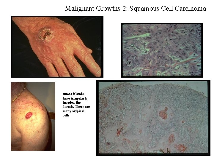 Malignant Growths 2: Squamous Cell Carcinoma tumor islands have irregularly invaded the dermis. There