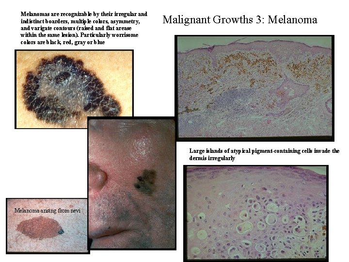 Melanomas are recognizable by their irregular and indistinct boarders, multiple colors, asymmetry, and varigate