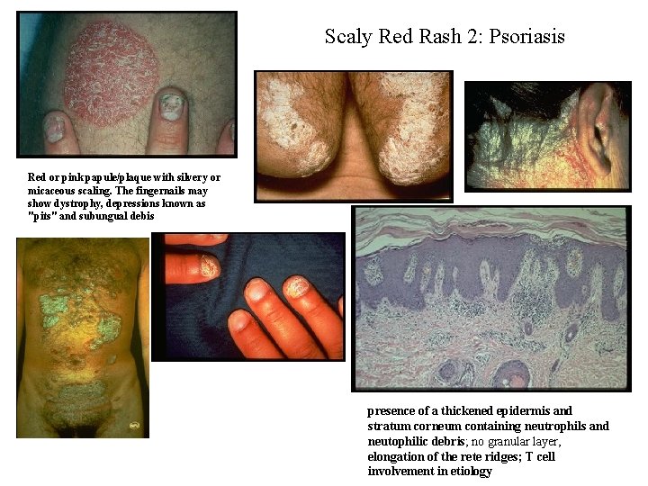 Scaly Red Rash 2: Psoriasis Red or pink papule/plaque with silvery or micaceous scaling.