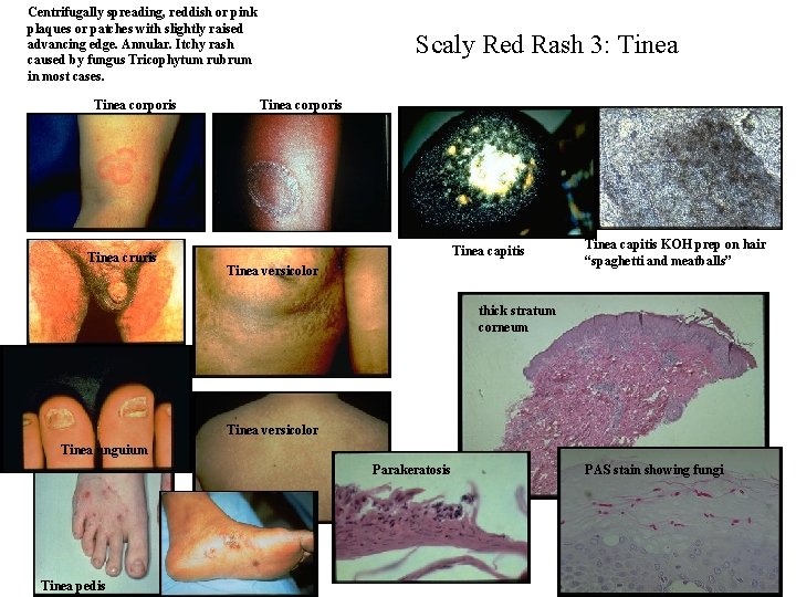 Centrifugally spreading, reddish or pink plaques or patches with slightly raised advancing edge. Annular.