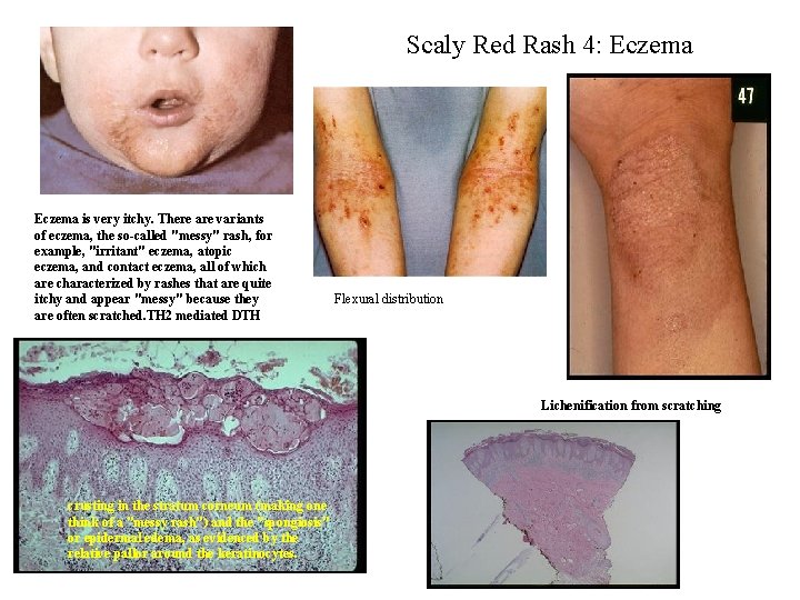 Scaly Red Rash 4: Eczema is very itchy. There are variants of eczema, the