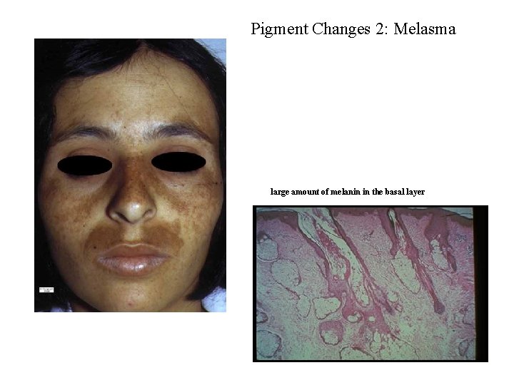 Pigment Changes 2: Melasma large amount of melanin in the basal layer 