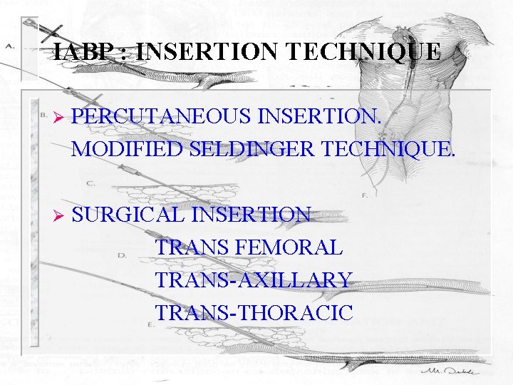 IABP : INSERTION TECHNIQUE Ø PERCUTANEOUS INSERTION. MODIFIED SELDINGER TECHNIQUE. Ø SURGICAL INSERTION TRANS