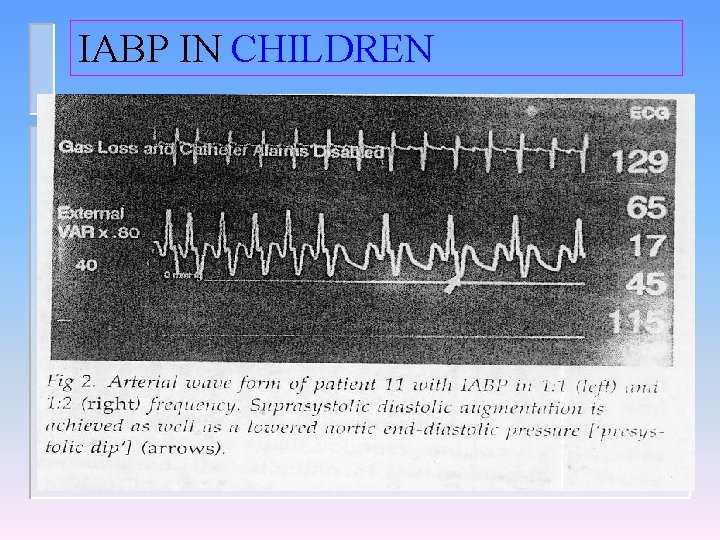 IABP IN CHILDREN 