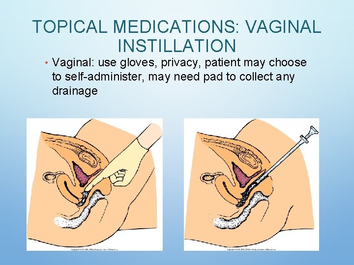 TOPICAL MEDICATIONS: VAGINAL INSTILLATION • Vaginal: use gloves, privacy, patient may choose to self-administer, TOPICAL MEDICATIONS: VAGINAL INSTILLATION • Vaginal: use gloves, privacy, patient may choose to self-administer,