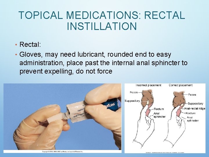 TOPICAL MEDICATIONS: RECTAL INSTILLATION • Rectal: • Gloves, may need lubricant, rounded end to TOPICAL MEDICATIONS: RECTAL INSTILLATION • Rectal: • Gloves, may need lubricant, rounded end to