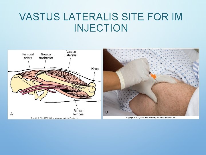 VASTUS LATERALIS SITE FOR IM INJECTION VASTUS LATERALIS SITE FOR IM INJECTION