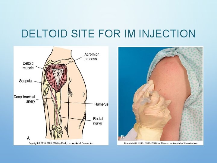 DELTOID SITE FOR IM INJECTION DELTOID SITE FOR IM INJECTION