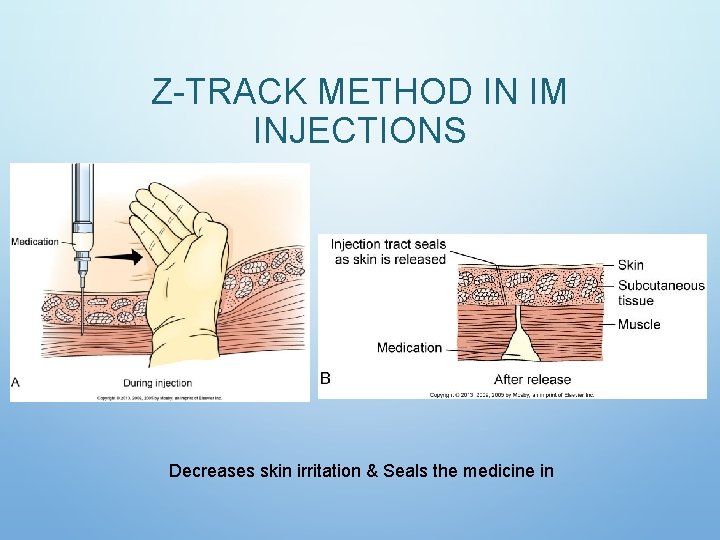 Z-TRACK METHOD IN IM INJECTIONS Decreases skin irritation & Seals the medicine in Z-TRACK METHOD IN IM INJECTIONS Decreases skin irritation & Seals the medicine in