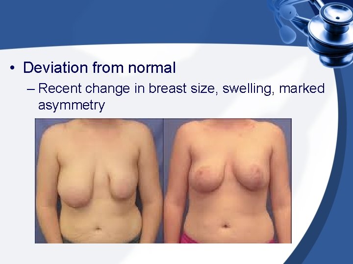  • Deviation from normal – Recent change in breast size, swelling, marked asymmetry