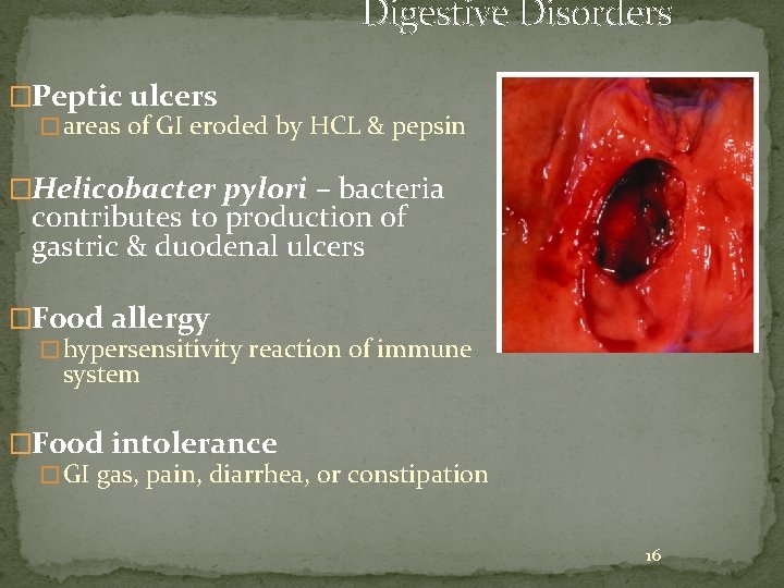 Digestive Disorders �Peptic ulcers � areas of GI eroded by HCL & pepsin �Helicobacter