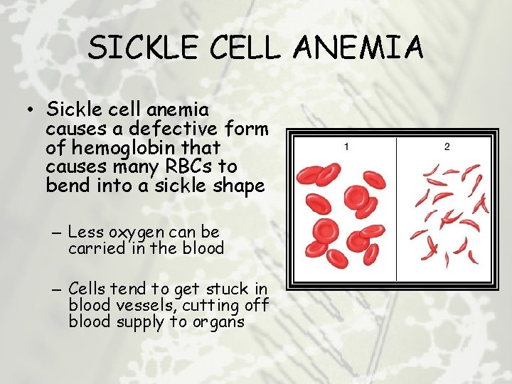 SICKLE CELL ANEMIA • Sickle cell anemia causes a defective form of hemoglobin that