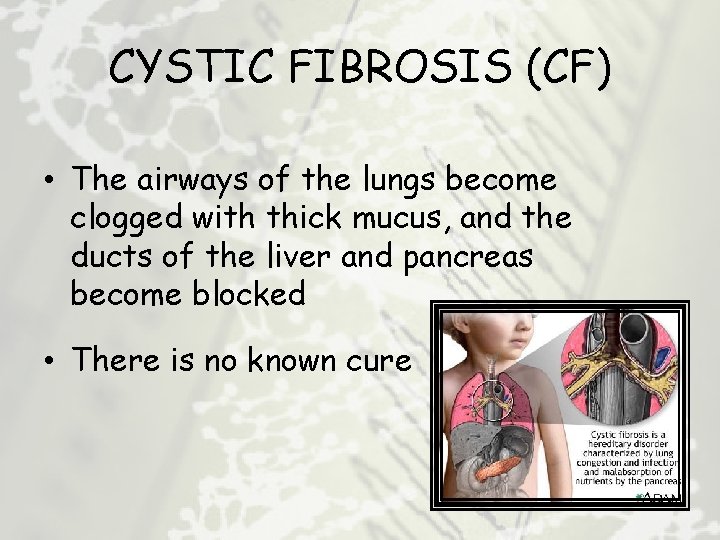 CYSTIC FIBROSIS (CF) • The airways of the lungs become clogged with thick mucus,