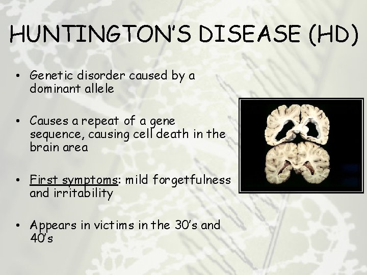 HUNTINGTON’S DISEASE (HD) • Genetic disorder caused by a dominant allele • Causes a