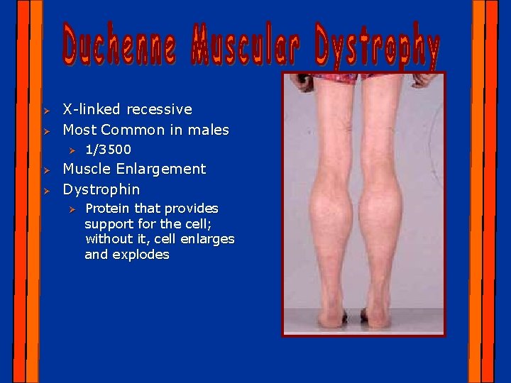 Ø Ø X-linked recessive Most Common in males Ø Ø Ø 1/3500 Muscle Enlargement
