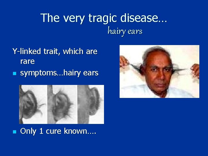 The very tragic disease… hairy ears Y-linked trait, which are rare n symptoms…hairy ears