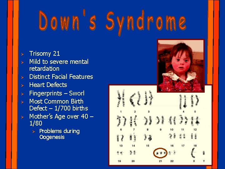 Ø Ø Ø Ø Trisomy 21 Mild to severe mental retardation Distinct Facial Features