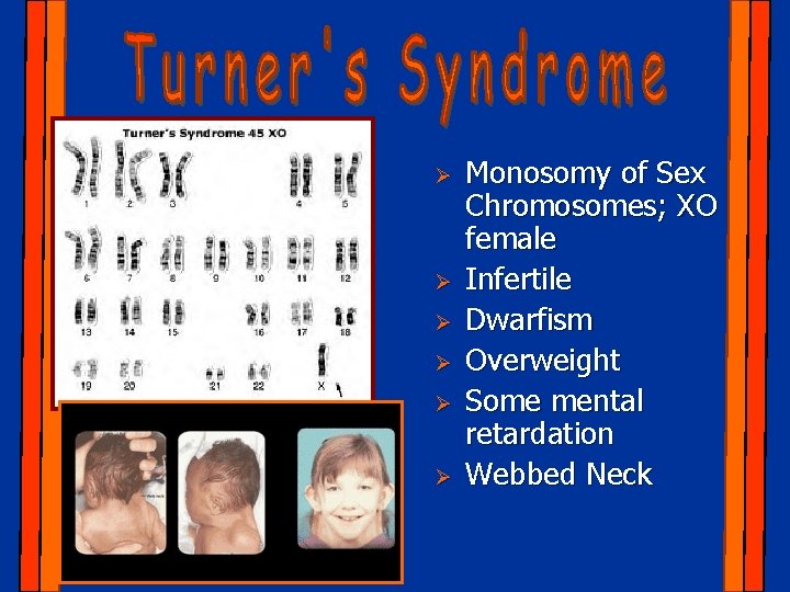 Ø Ø Ø Monosomy of Sex Chromosomes; XO female Infertile Dwarfism Overweight Some mental