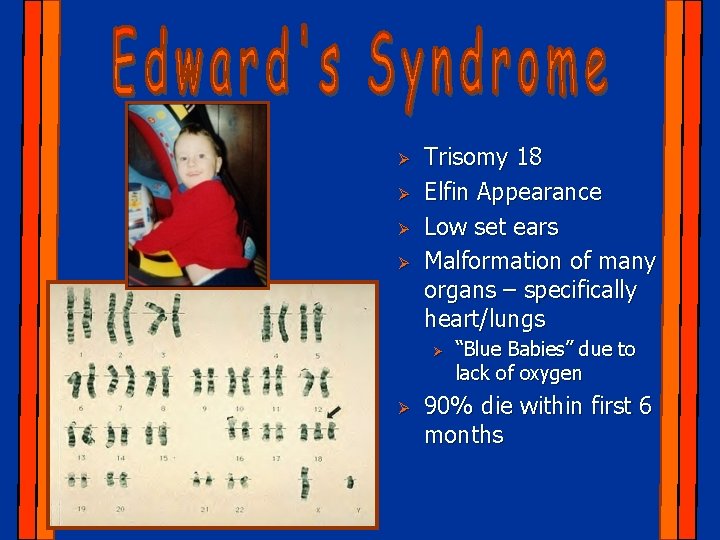 Ø Ø Trisomy 18 Elfin Appearance Low set ears Malformation of many organs –