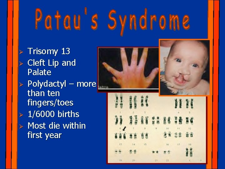 Ø Ø Ø Trisomy 13 Cleft Lip and Palate Polydactyl – more than ten
