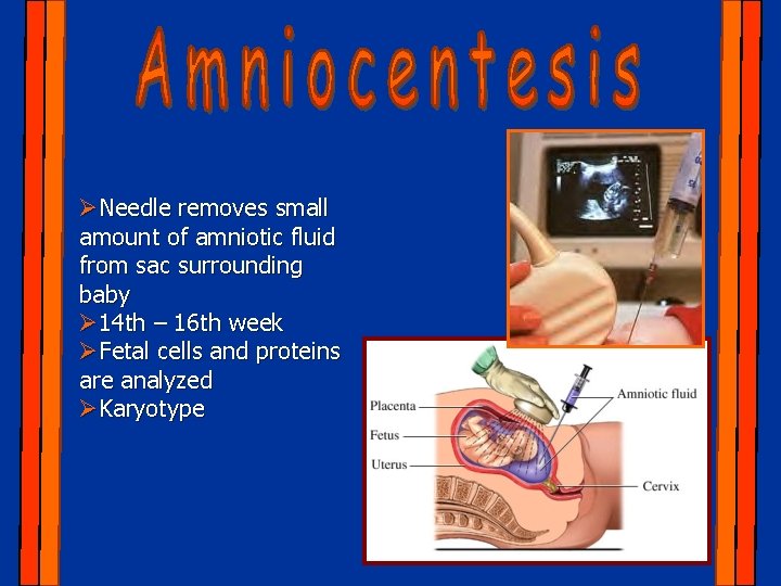 ØNeedle removes small amount of amniotic fluid from sac surrounding baby Ø 14 th