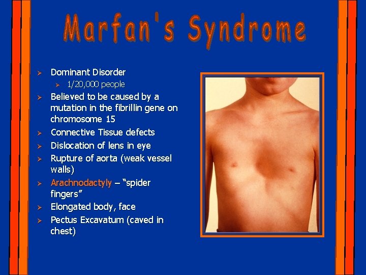 Ø Dominant Disorder Ø Ø Ø Ø 1/20, 000 people Believed to be caused